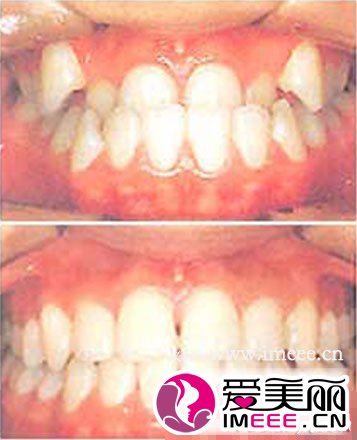 牙齿矫正对比图