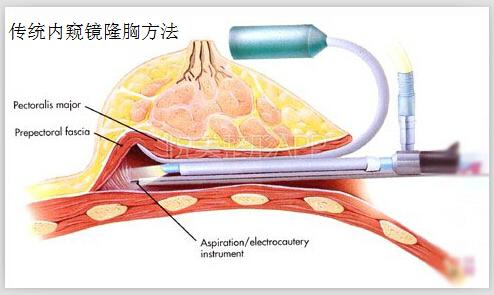 栾杰：怎么隆胸不那么疼？做内窥镜隆胸