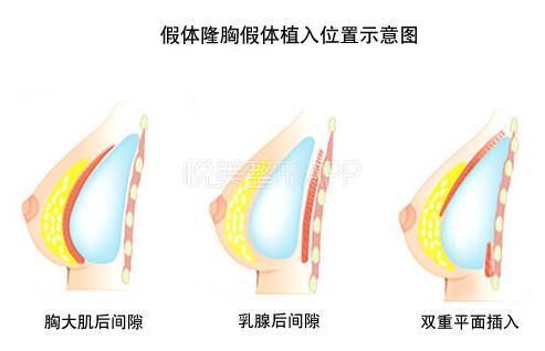 栾杰：怎么隆胸不那么疼？做内窥镜隆胸