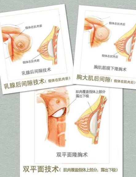 谢卫国院长：水滴形隆胸假体不一定适合你!