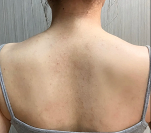 后背疙疙瘩瘩不敢穿露背